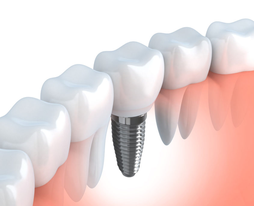Dental Implants
